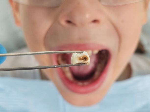 Best Emergency Wisdom Teeth Removal in Jefferson, GA